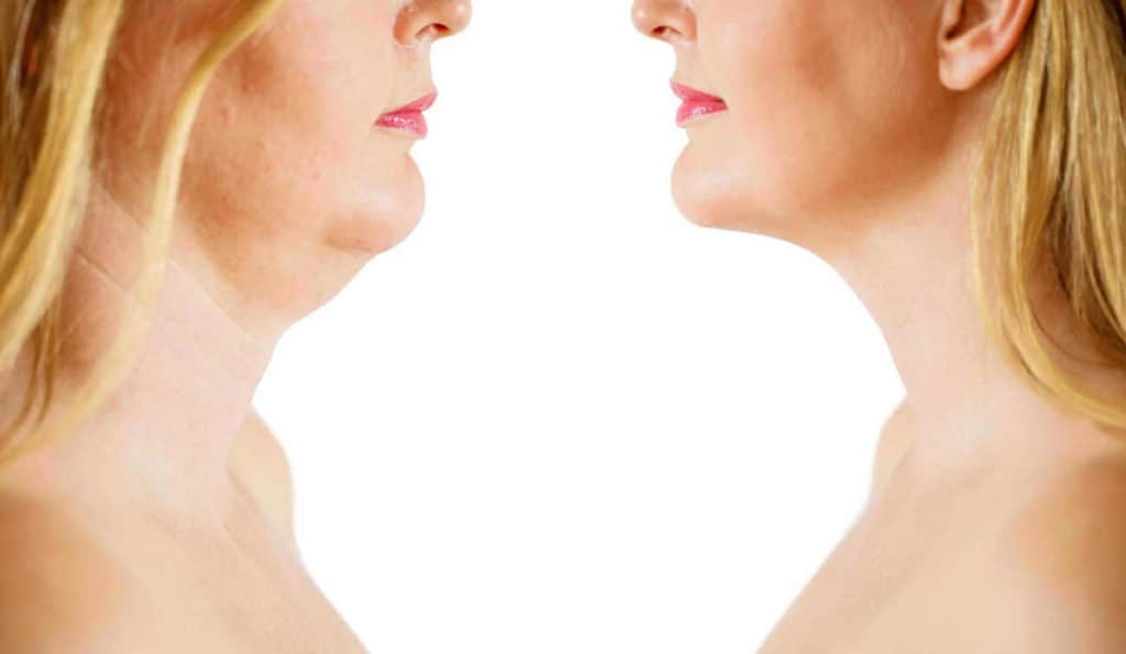 Double Chin treatment Kew before and after results