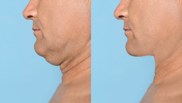 Which Non-Surgical Treatments Work Best for Jowls and Loose Skin Kew?