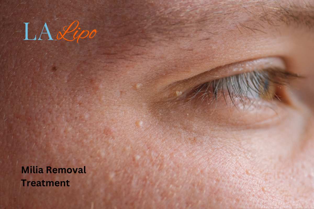 Cryopen Milia Removal: Is It the Easiest and Safest Option Kew?