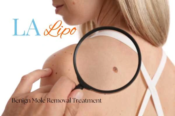 Why getting moles removed Kew can boost your confidence!