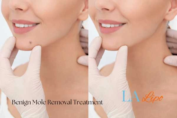 Woman's before and after results of being moles removal treatment Kew