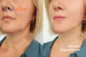 hi-fu for wrinkles Kew before and after results