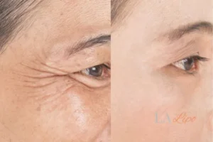 Before and after results of woman - HI-fu wrinkles reduction treatment Kew