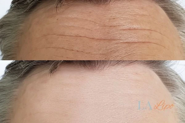 results of HIFU Kew on mans forehead to help reduce lines and wrinkles