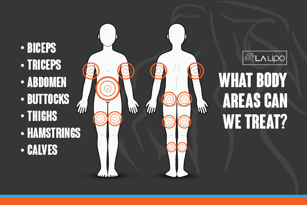 Graphic to show areas you can have LA-EMS Body Sculpting Kew treatment.