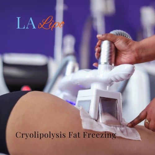fat freezing - Cryolipolysis Kew