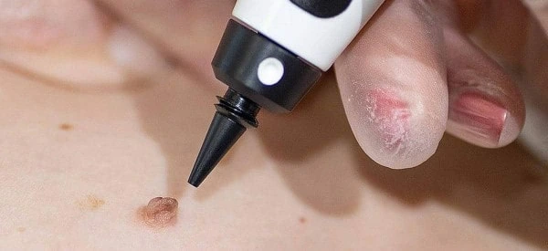 skin tag removal using cryopen Kew