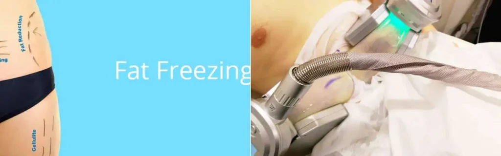 Fat freezing Kew on multiple areas of the body