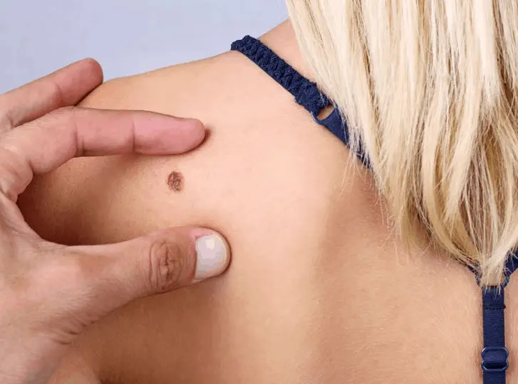 woman having mole removal Kew consultation before treatment.