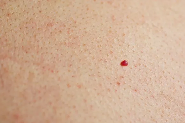 close up of a cherry angioma Kew