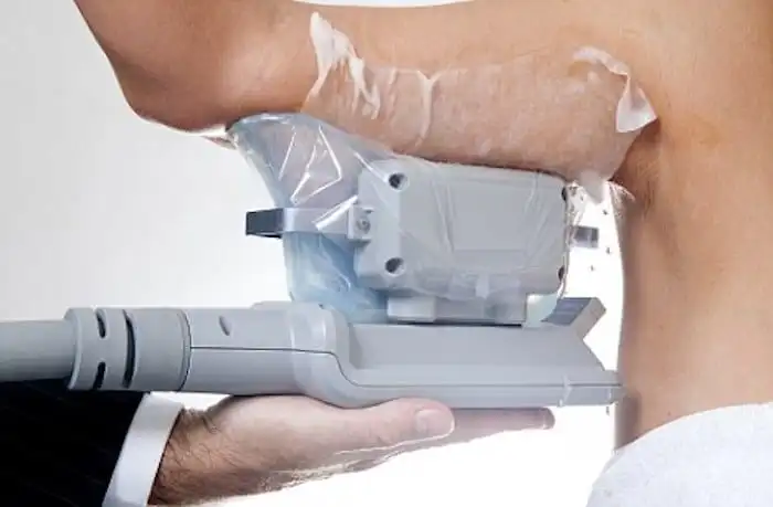 Picture of fat freezing Kew on the upper arms.
