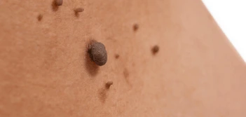 image of a skin tag Kew