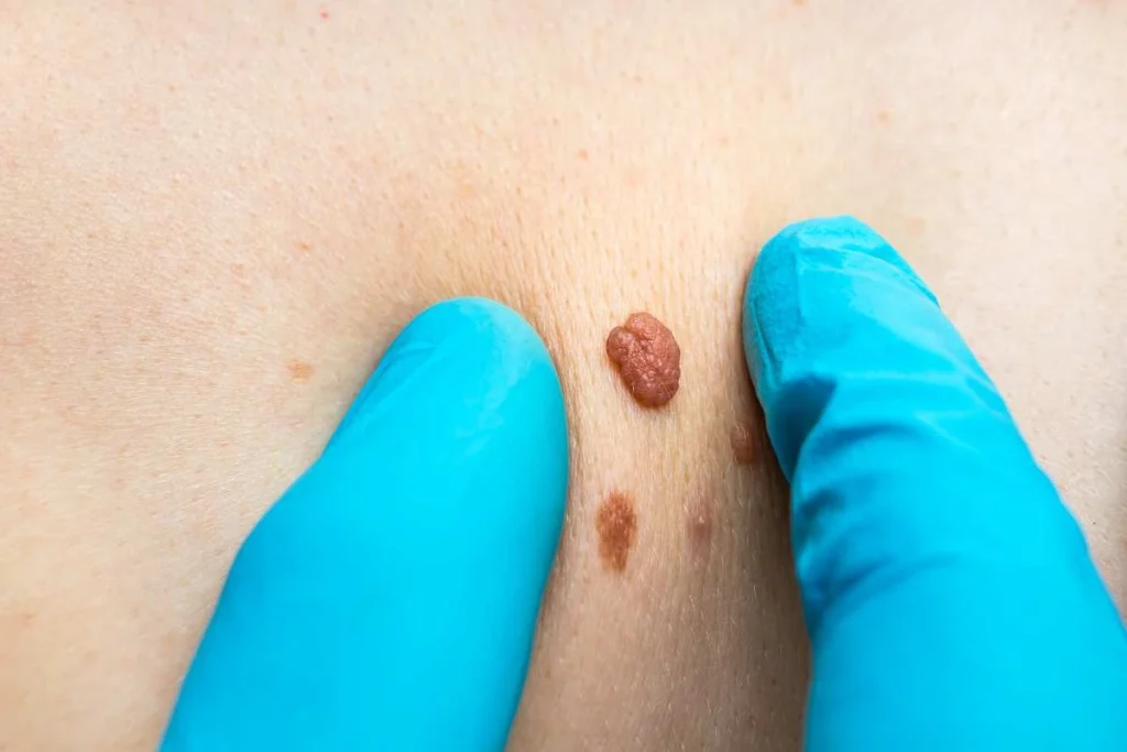 Consultant examining a skin tag Kew