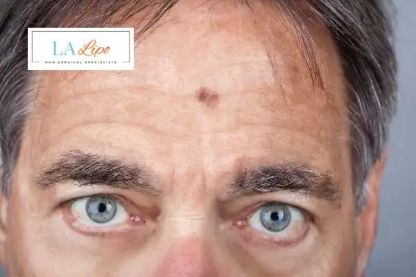 Solar Lentigo Removal Kew image of man with mark on his forehead