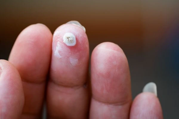 wart on person finger - cryotherapy to treat from LA LIPO Kew