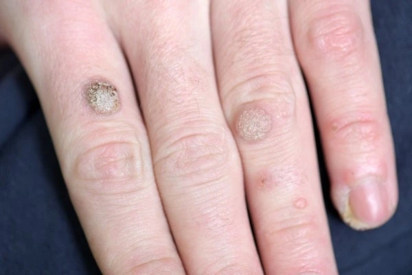 photo of warts on person hand - see wart removal Kew from LA LIPO