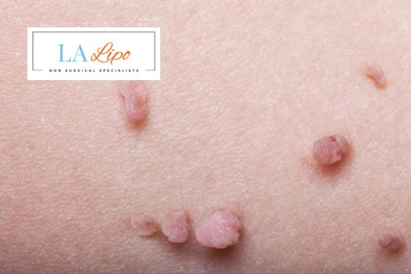 Does cryopen skin tag removal Kew hurt? Find out now call our team today!