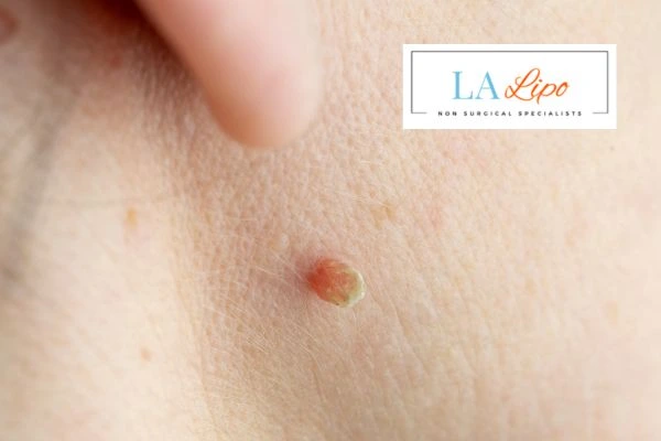 Book skin tag removal Kew today speak to our team now!