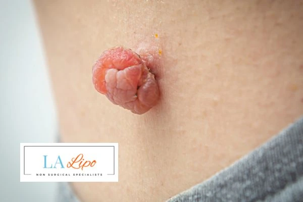 Interested in skin tag removal Kew? Concerned about the pain? Find out more today!