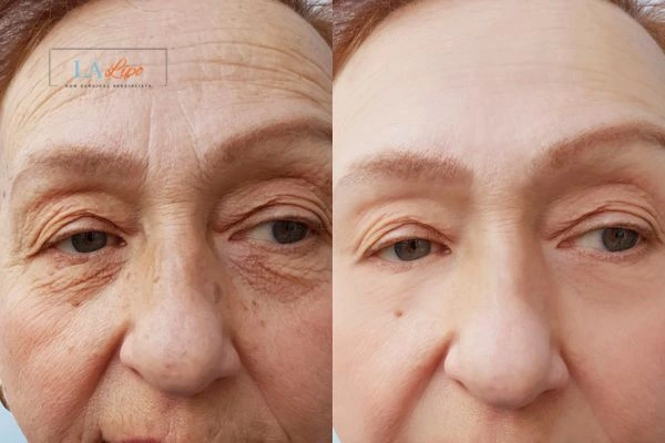 The powerful benefits of Morpheus8 Treatment Kew - Call Our team today!