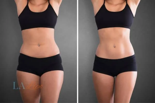 before and after results of non-surgical treatment to help a woman's body image and mental health Kew