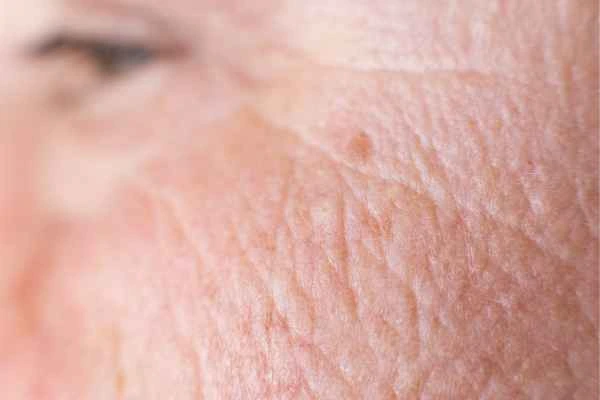 close up picture of a woman's face showing an age spot Kew