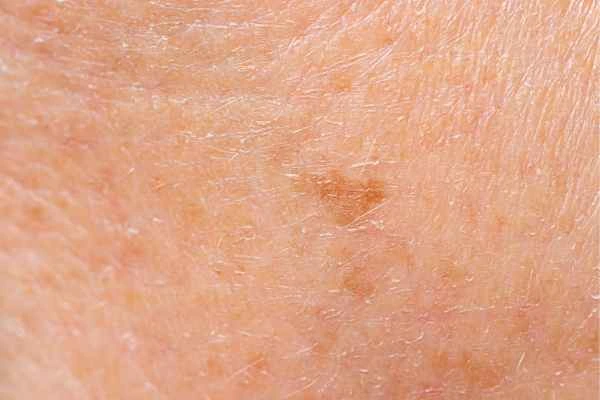 close up picture of age spots Kew