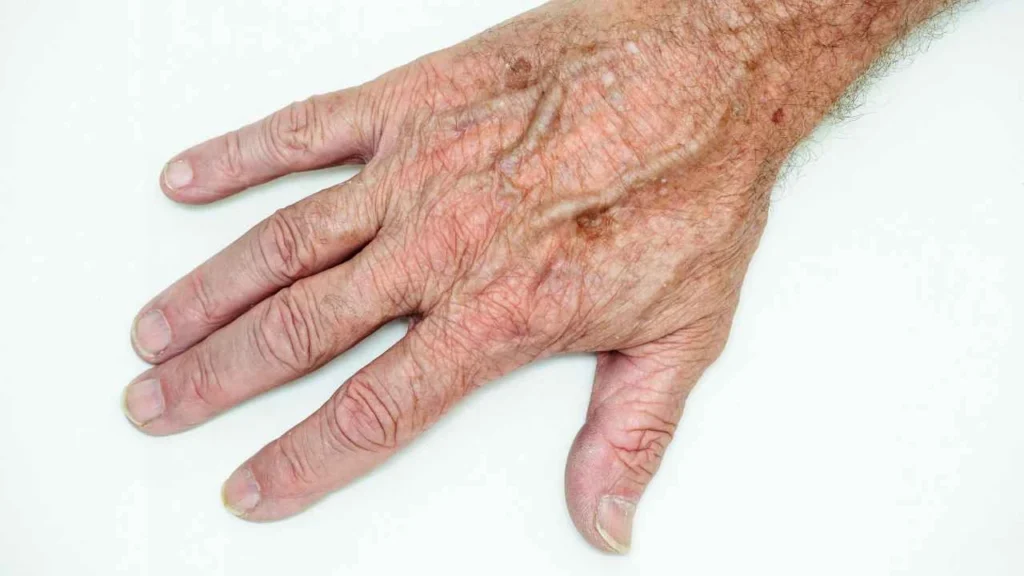 Male hand showing age spot Kew