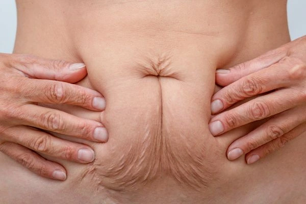 Image of a woman's stomach with loose skin - example of skin tightening Kew options