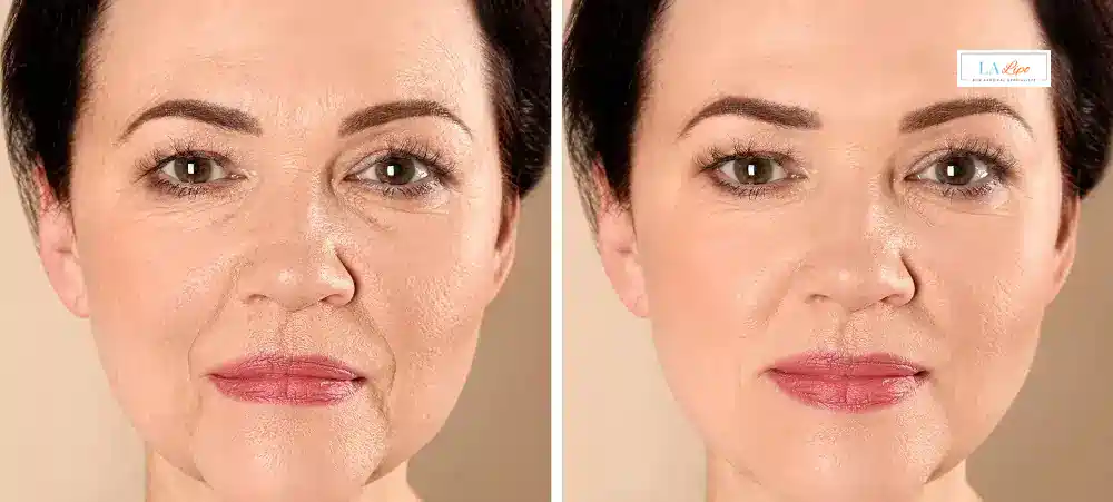 How Long Does It Take to See Results and How Long Do They Last Kew?