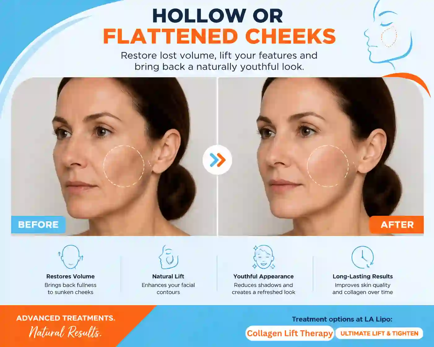 Sign #4: Hollow or Flattened Cheeks Kew